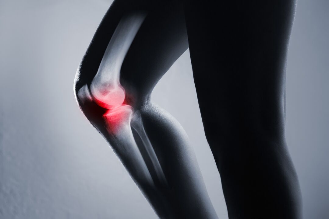 upala zgloba koljena s artrozom