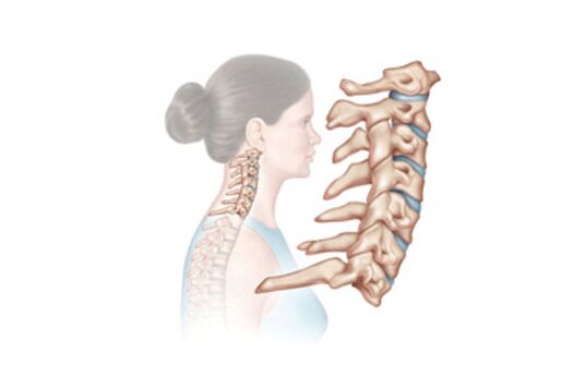 oštećenje vratne kralježnice s osteohondrozo