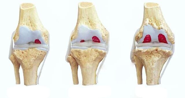 faze osteoartritisa koljena