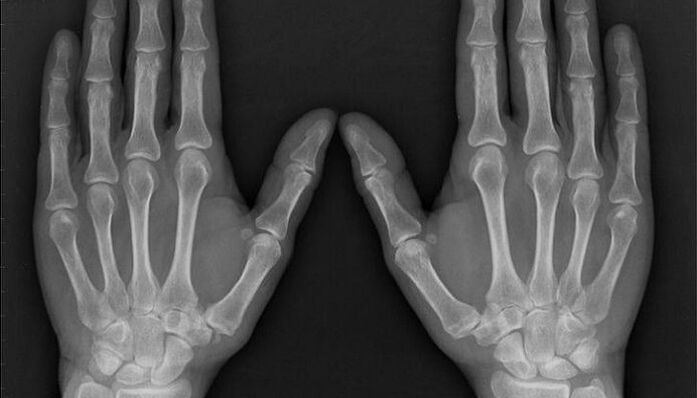 rendgen za dijagnostiku artritisa i artroze