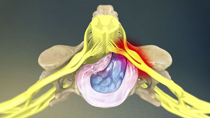 Jedan od uzroka bolova u leđima je hernija diska. 