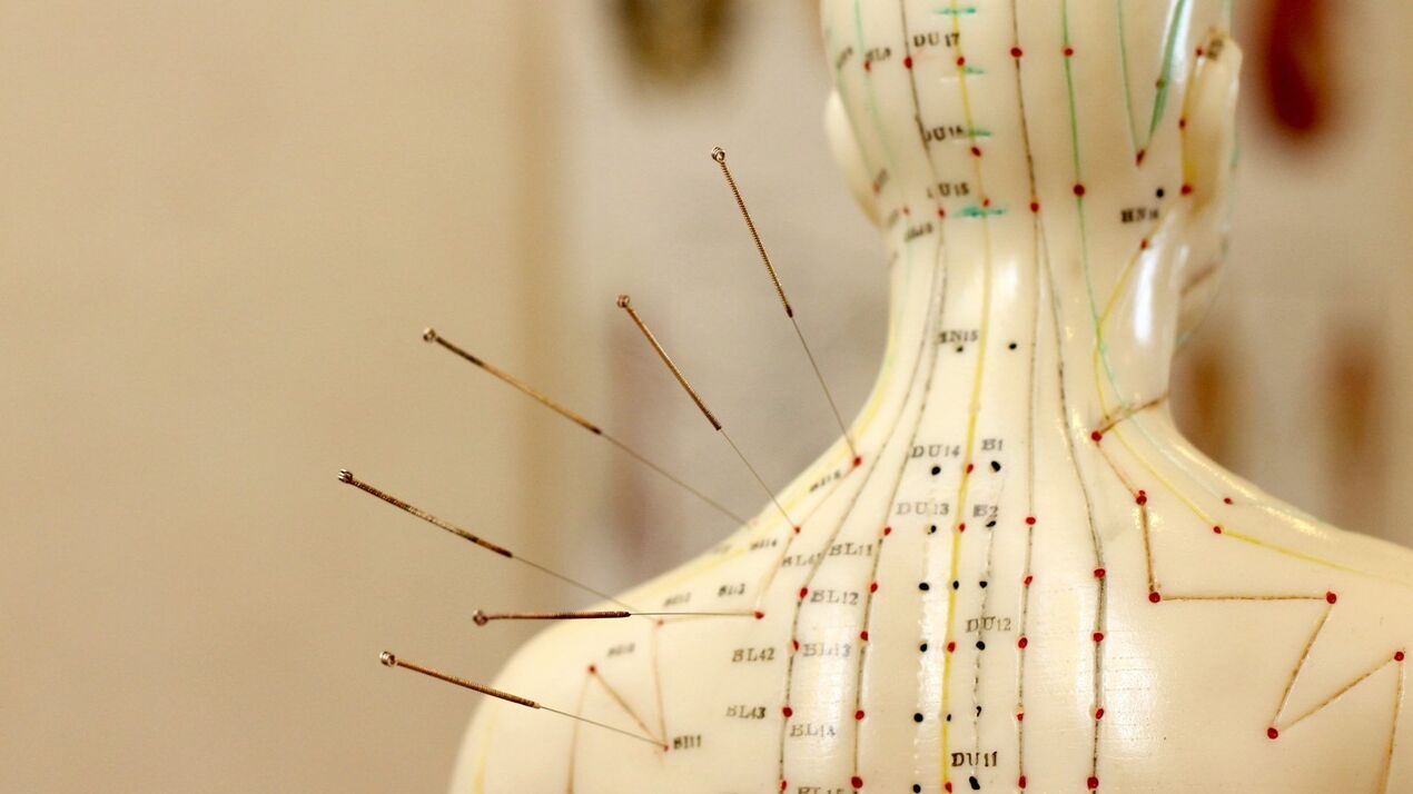 akupunktura za cervikalnu osteohondrozu