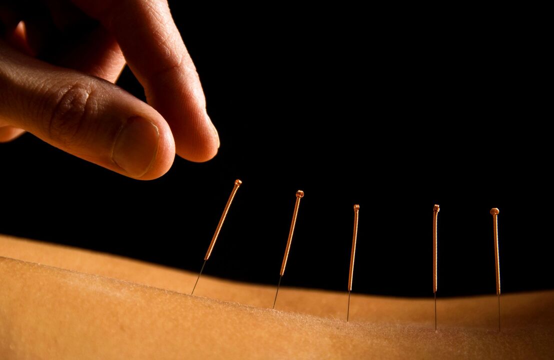 akupunktura za bolove u leđima