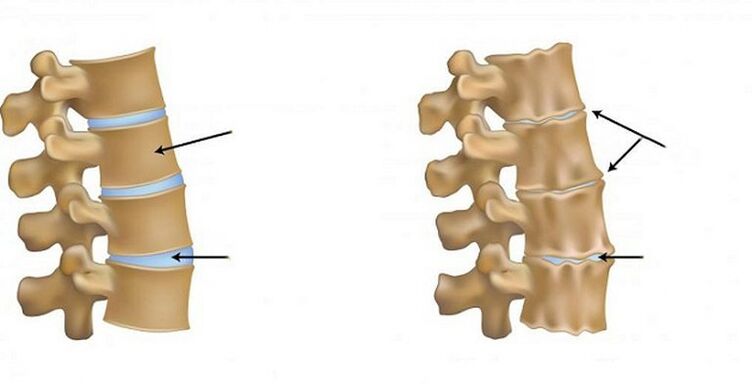 Ishemijski sindrom za osteohondrozu