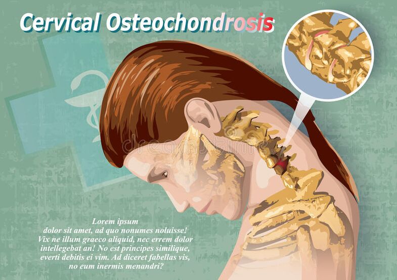 cervikalna osteohondroza je bolest hrskavice tkiva